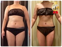 40代女性（ハイパーナイフ）