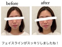 整体院 TBCC 天神本院/小顔矯正　フェイスライン