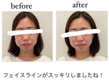 整体院 TBCC 天神本院/小顔矯正　フェイスライン