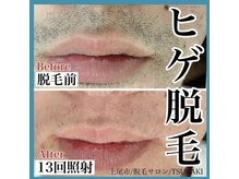 ツバキ(TSUBAKI)/ヒゲ脱毛