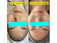 エステティックサロン Sの雰囲気（くすみが飛んで華やかに♪全体的にお悩みが薄くなっています。）