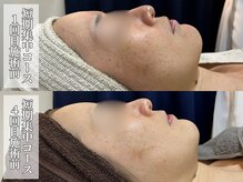 サロンノワ(salon noix)/《諦めないでシミ・ニキビケア》