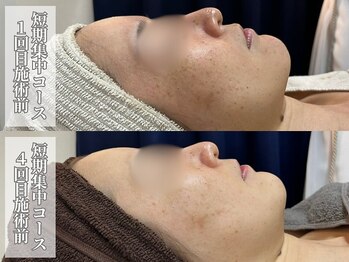 サロンノワ(salon noix)/《諦めないでシミ・ニキビケア》