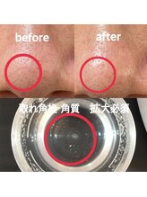 シェリー(Cheri)/【イチゴ鼻】毛穴洗浄洗浄・吸引