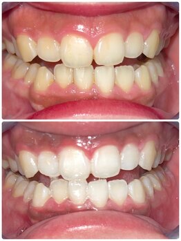 エクシアホワイトニング 町田店/ホワイトニングビフォーアフター