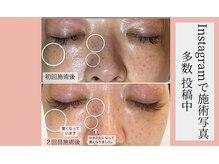 トリートメントサロンビューティープラス(Treatment Salon Beauty+)の雰囲気（大人気のシミケア。施術2回でかなりの効果◎）