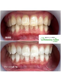 ホワイトニングサロン 名古屋駅店/【ホワイトニング施術例】