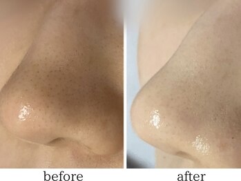 ホーミー(Homie)/毛穴黒ずみ、毛穴開き改善