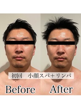 ラノン(LANON)/ビフォーアフター2