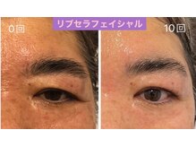 プリュネル(Prunelle)/プラズマシャワー