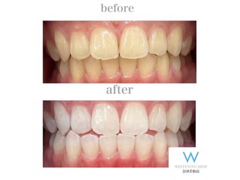 ホワイトニングショップ 会津若松店/Before&After美白ホワイトニング