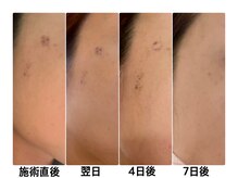 アマラ(Amarra)/濃いシミの経過