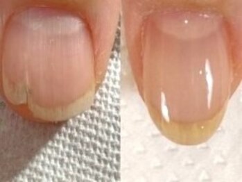 ミノン(MINON)の写真/【巻き爪・深爪も対応◎】爪のコンプレックスに寄り添う☆自爪育成にも力を入れるサロン！