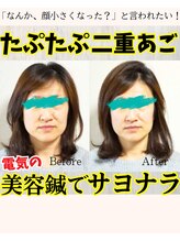 美容鍼＆首肩こり骨盤整体サロン ひふね/50代 美容鍼 Before/After