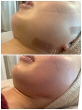 エルール トータルビューティ(Aileure total beauty)/ダウンタイムケア　フェイシャル