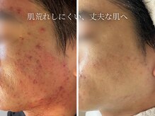 ハナコ 下通店(HANAKO)/【健康な肌づくり】