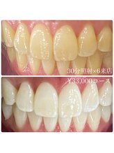 ホワイトニングルーム 横浜店(Whitening Room)/セルフホワイトニング/横浜
