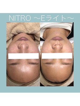 ビーダブリュー(BW...)/Eライト（光＋高周波)トーンUP