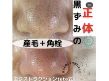 アイシェリー(eyecherie)/毛穴エクストラクション