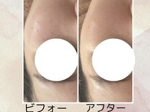 カリアンヌ/大人ニキビも毛穴洗浄