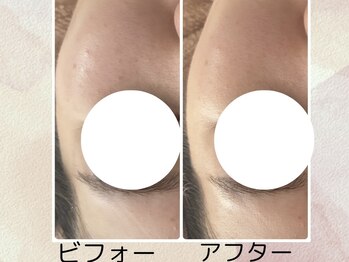 カリアンヌ/大人ニキビも毛穴洗浄