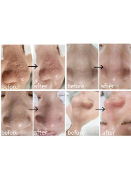 毛穴ケアをしたい