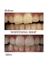 ホワイトニングショップ 銀座7丁目店(WHITENING SHOP)/Before After