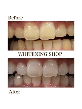 ホワイトニングショップ 銀座7丁目店(WHITENING SHOP)/Before After