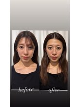 マホロバ(mahoroba)/ダーマ鍼美容鍼ビフォーアフター