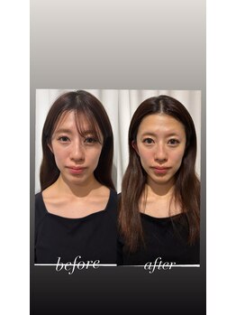 マホロバ(mahoroba)/ダーマ鍼美容鍼ビフォーアフター