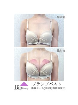 バイオビューティー 神戸本店(Bio Beauty)/プランプバスト　施術症例