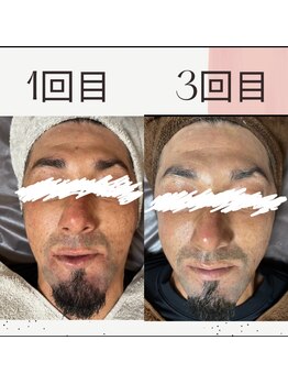 ミルル(milulu)/回を重ねるごとに肌質改善！