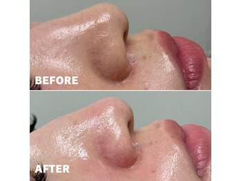 ベレア(BELEA)/お肌のザラ付きも改善！