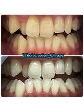 ホワイトニングショップ 武蔵小杉店/【BeforeAfter】8回 施術後比較