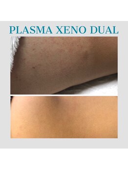 ビーダブリュー(BW...)/肌質改善プラズマゼノデュアル☆