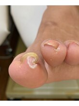 フットメンテ 巻き爪矯正センター 南浦和/巻き爪