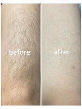 アトレ(Atre)/メンズ太もも脱