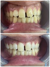 グロウ 東区香椎(GLOW)/美容ホワイトニング