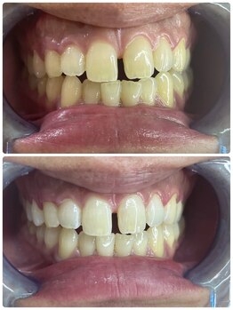 グロウ 東区香椎(GLOW)/美容ホワイトニング