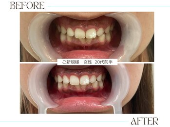 ホワイトニングサロンブライト 尼崎店(Whitening salon bright)/ご新規様のbefore/after
