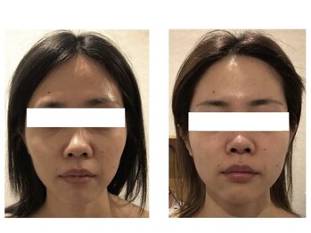 デディア 恵比寿(dedia)/サーマトリックス/ほうれい線