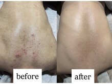 ビー ブルーム(B BLOOM)/【ニキビケア】繰り返さない肌へ