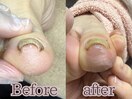 【巻き爪・分厚い爪】