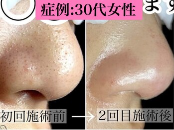 ラボキュー(LABO-9)/30代女性毛穴症例写真