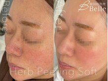 ベル 目黒(Belle)/ハーブピーリング|ニキビケア