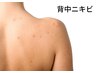 【夏の肌見せに】清潔感あふれる美背中へ！背中ニキビ集中ケア