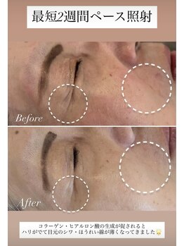 グランドシャルムエス(Grand Charme S)/IPL光フェイシャル5回目照射後