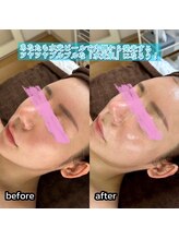 エムアイ 六本木(Mi)/ぷるぷる透明感！水光ピール^ ^