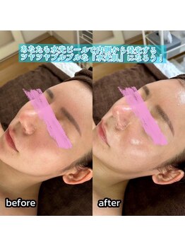 エムアイ 六本木(Mi)/ぷるぷる透明感！水光ピール^ ^