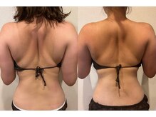 ユー 喜連西店(U)/脂肪冷却【before　after】